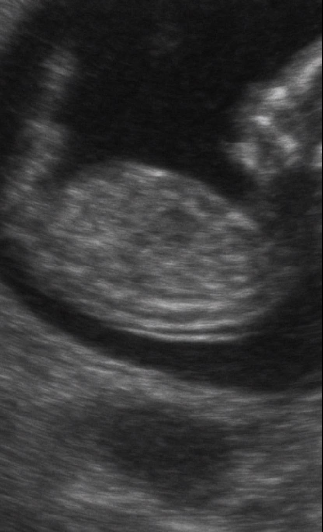 Pregnancy ultrasound shared by an anonymous client